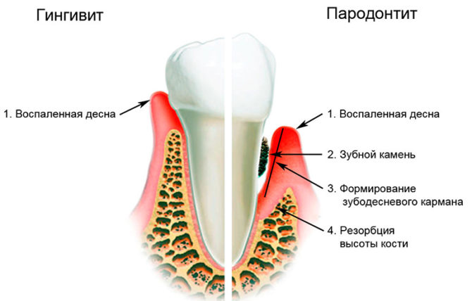 Ang pag-unlad ng gingivitis at periodontitis