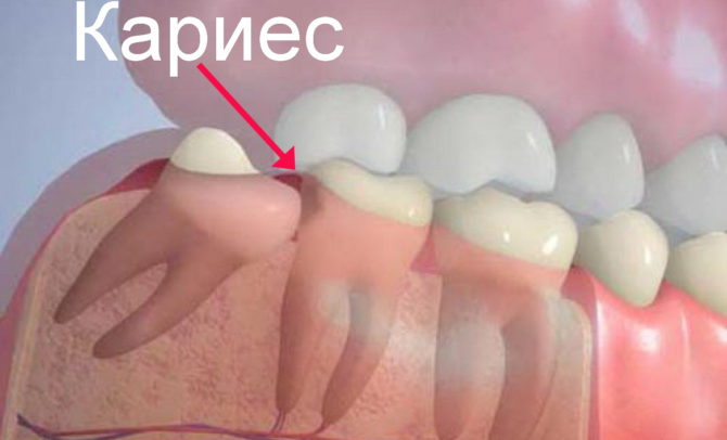 Ang pag-unlad ng karies sa pangalawang molar dahil sa isang hindi wastong pagsabog ng ngipin ng karunungan