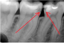 Radiographie d'une dent carieuse