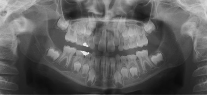 X-ray ng mga ngipin ng gatas at ang mga rudiment ng permanenteng