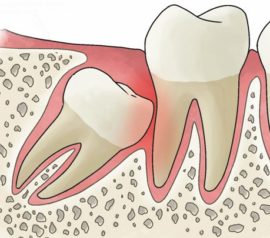 Ang Retarded Wisdom Tooth