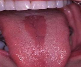 Diamond Glossitis