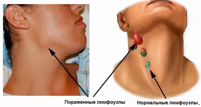 Ang mga servikal na lymph node sa isang normal at namumula na estado