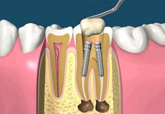 Épingle à dents