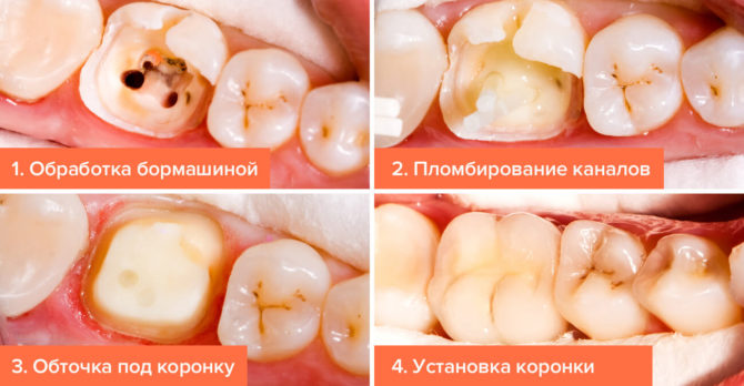 Schéma thérapeutique pour les caries profondes