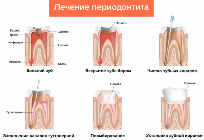 Regimen sa paggamot ng periodontontitis