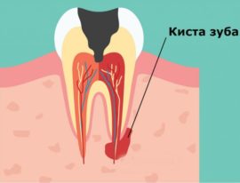 Le schéma de la formation des kystes dentaires