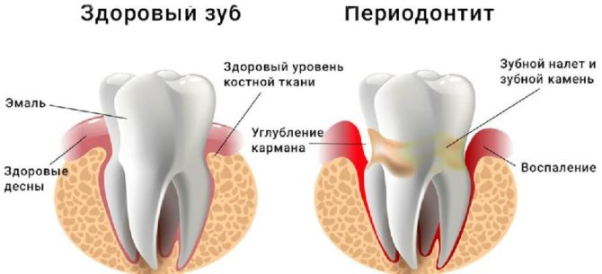 Schéma vzniku paradentózy