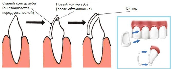 Diagram ng pag-install ng Veneer