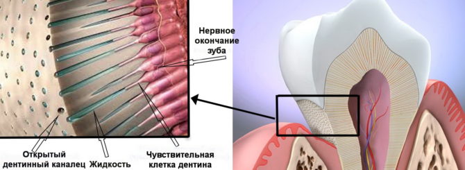 Schéma výskytu zubů s otevřenými dentinovými tubuly (2)