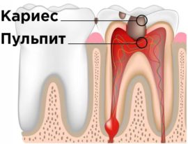 Pulpitis Schematic