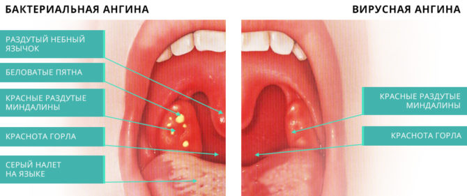 Mga sintomas ng pamamaga ng tonsil