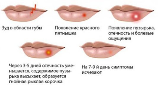 Mga Sintomas ng Herpes