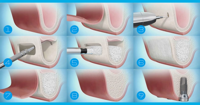 Lifting des sinus