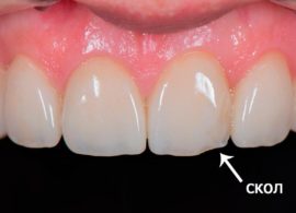 Couronne écaillée sur la dent avant