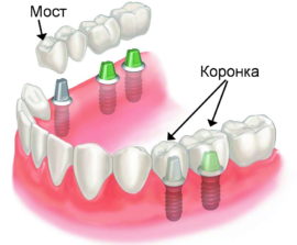 Metody zubní protetiky pomocí implantátů