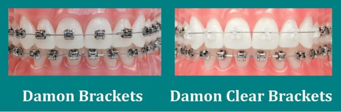 Comparaison des croisillons Damon et Damon Clear conventionnels