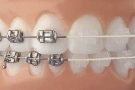 Photo comparative des croisillons en métal et en céramique