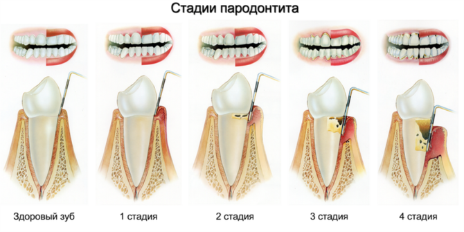 Mga yugto ng Periodontitis