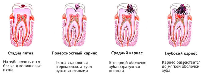 Étapes de la carie