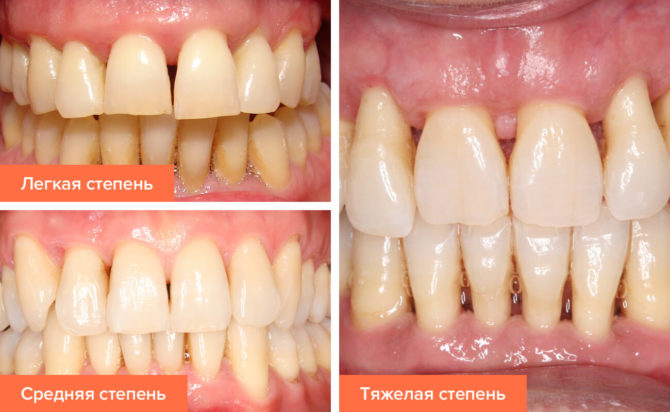 Mga yugto ng sakit sa periodontal