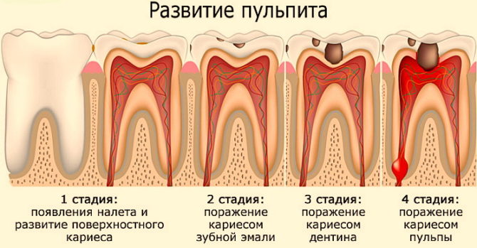 Stades de développement de la pulpite