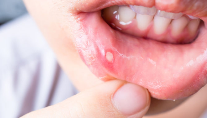 Is stomatitis contagious in children and adults, how is stomatitis ...