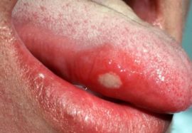 Stomatitis sa dila (glossitis)