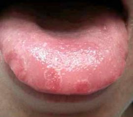 Streptokokové impetigo