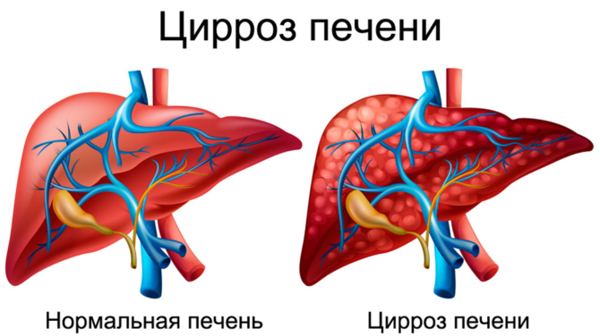 Cirrhosis