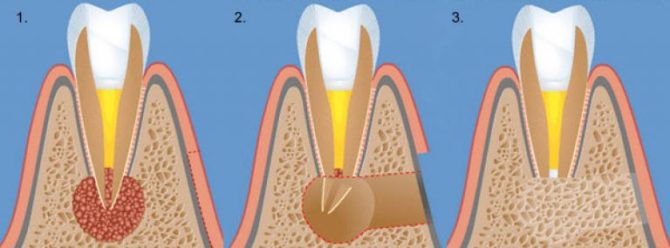 Cystectomie