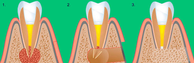 Cystectomy