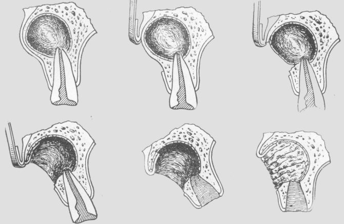 Cystotomy