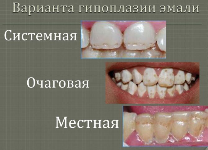 Types d'hypoplasie de l'émail