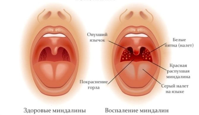 Tonsillitis