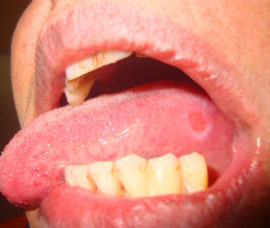 Traumatic glossitis