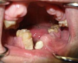 Traumatic osteomyelitis ng mas mababang panga