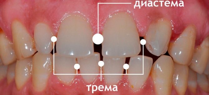 Tremas at diastema