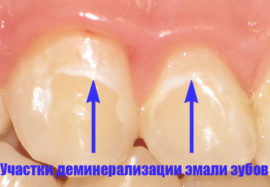 Demineralizační stránky zubních sklovin