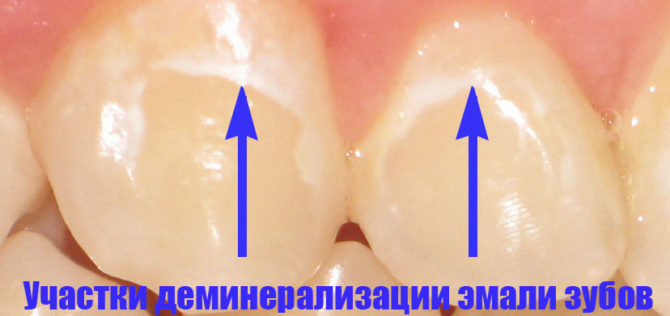 Dental enamel demineralization site