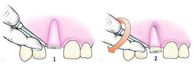 Extraction de dents par ascenseur