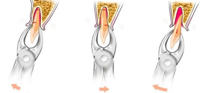 Extraction d'une dent de sagesse avec une pince