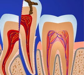 Extraction dentaire en plusieurs parties