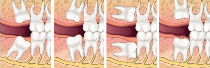 Mauvaises options de croissance des dents