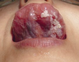 Ang verrucous leukoplakia ng oral cavity