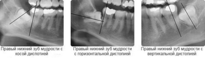 Types de dystopie des dents de sagesse