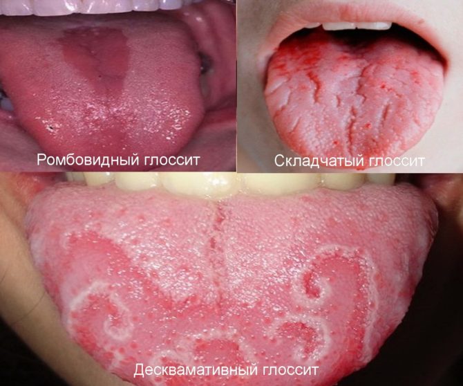 Druhy glositidy se symptomy ve formě trhlin v jazyku