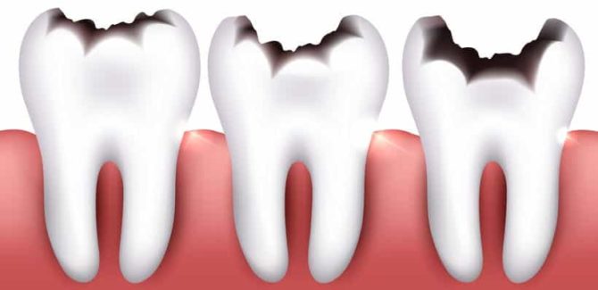 Types de caries