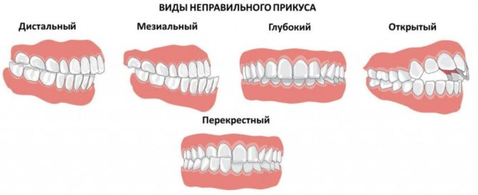 Types de malocclusion