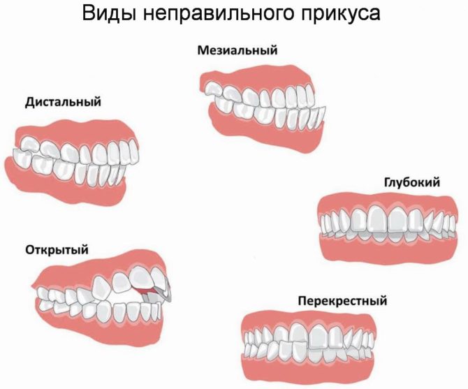 Druhy malocclusion